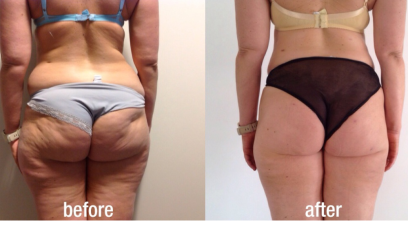 Фотона Боди 6